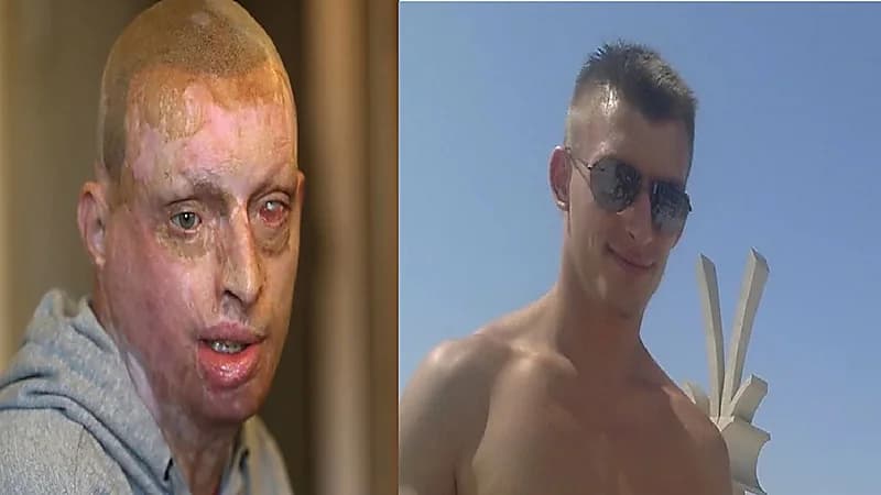 فتاة تسكب مادة حارقة على وجه زوجها أثناء نومه بسبب خلاف بسيط