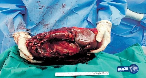 طبيبة سعودية تتمكن من استئصال ورم من بنكرياس مريض يزن 4.5 كجم