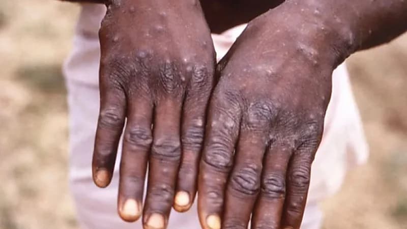 بلجيكا أول دولة تطبق الحجر الصحي ضد جدري القرود