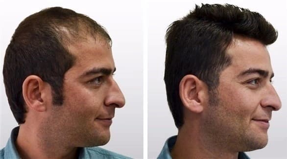 3 حقائق هامة عن زراعة الشعر
