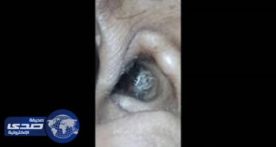 بالفيديو.. عنكبوت يتحرك داخل أُذن سيدة