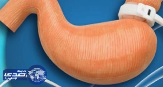 دراسة: جراحات السمنة تدمر خصوبة الرجال