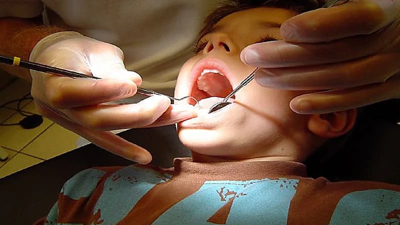 ما لا تعرفه عن الحشوات السادة اللاصقة للأسنان عند الأطفال