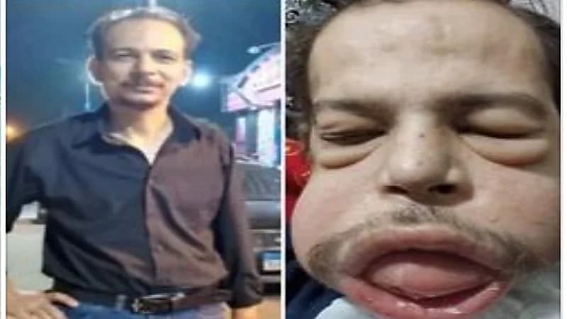 خطأ طبي يصيب مصري بمرض نادر يمنعه من الأكل طوال حياته