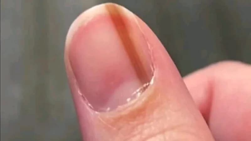 سيدة عانت من خط تحت ظفرها لتكتشف بعد ١٠ سنوات أنه ورماً سرطانياً