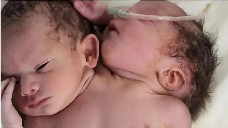 حالة نادرة.. سيدة تلد توأم برأسين و3 أذرع