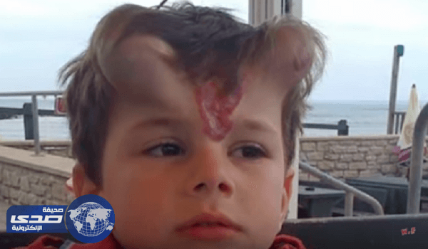 بالصور.. طفل ببقعة وقرنين .. شاهد كيف أصبح ؟