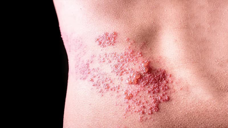 طبيب : الحزام الناري قد يسبب العمى .. فيديو