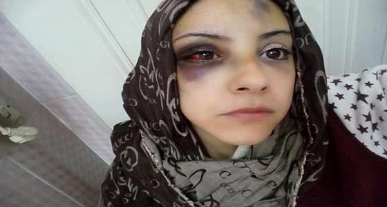 بالصور.. الاعتداء على مطلقة بالضرب للتنازل عن مستحقاتها
