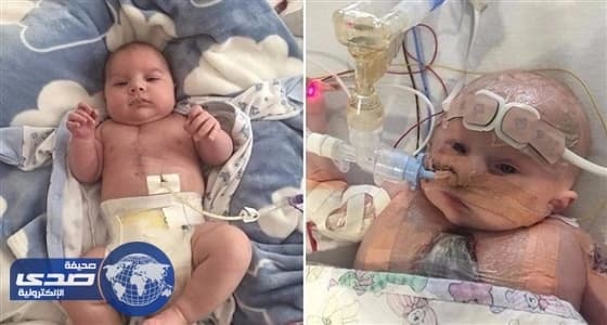 طفل بنصف قلب يُخالف توقعات الأطباء وينجو من الموت