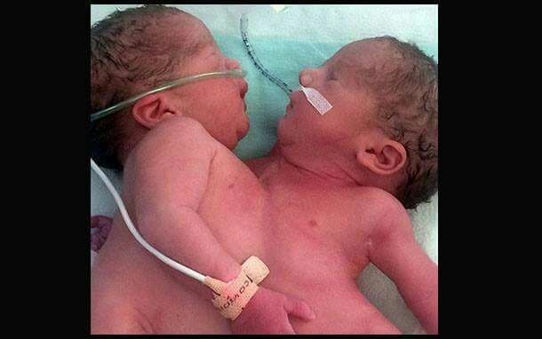 تركية تلد توأم ملتصق بكبد واحد في حالة نادرة