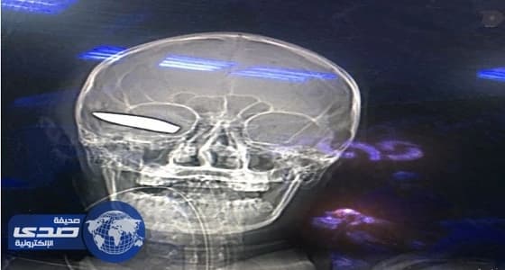 فريق طبي بجازان يستخرج طلقة من رأس أحد جنود التحالف العربي