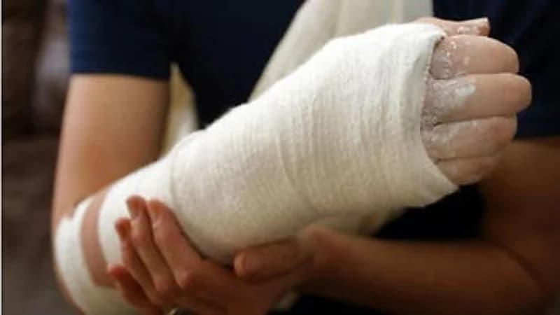 خبراء يوضحون المدة التي تستغرقها الكسور لكي تلتئم