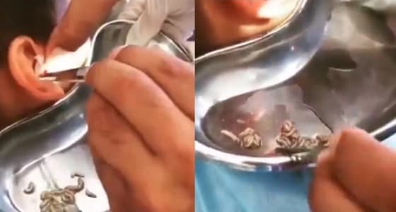 لقطات مروعة لإخراج عشرات الديدان الحية من أذن طفل