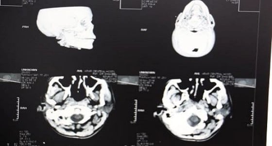 إنقاذ حياة مقيم تعرض لحادث دهس في عرعر