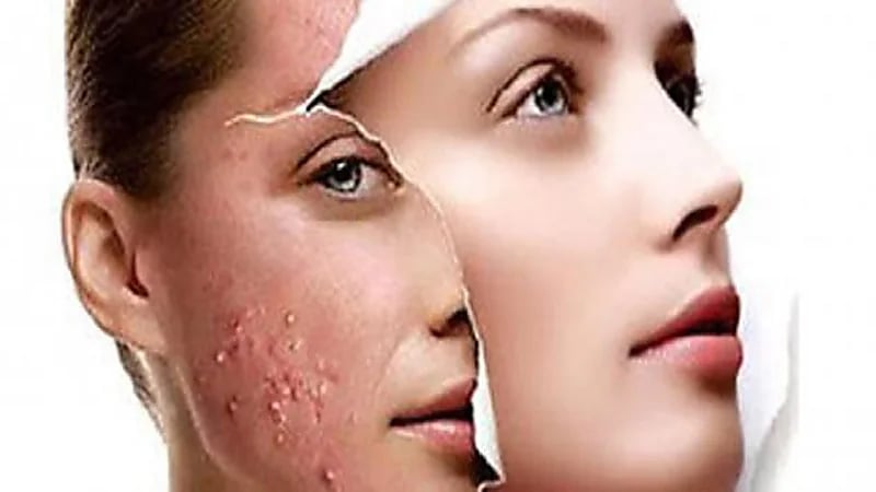 "الخميرة والملفوف" مواد منزلية لعلاج آثار حب الشباب