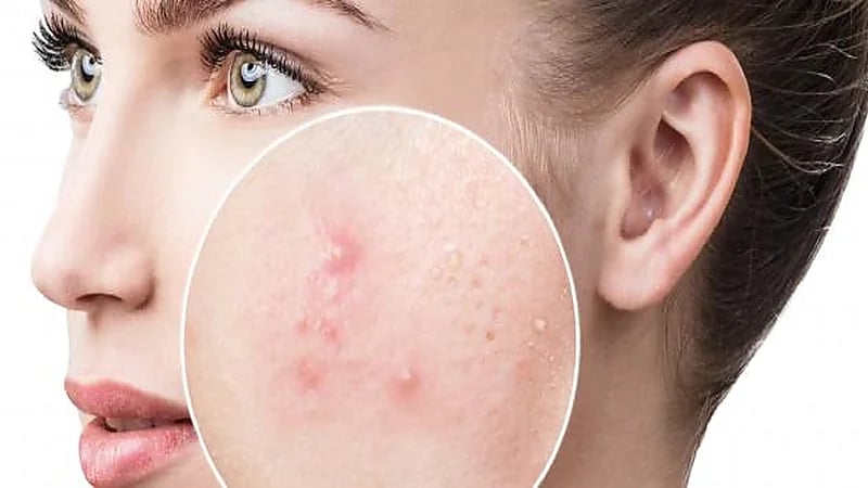 أخصائي تجميل يوضح أسباب حب الشباب وحفر الوجة وكيفية علاجهما(فيديو)