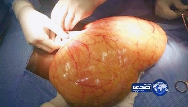 استئصال زائدة دودية لمريض طولها 20 سم بمستشفى صامطة العام