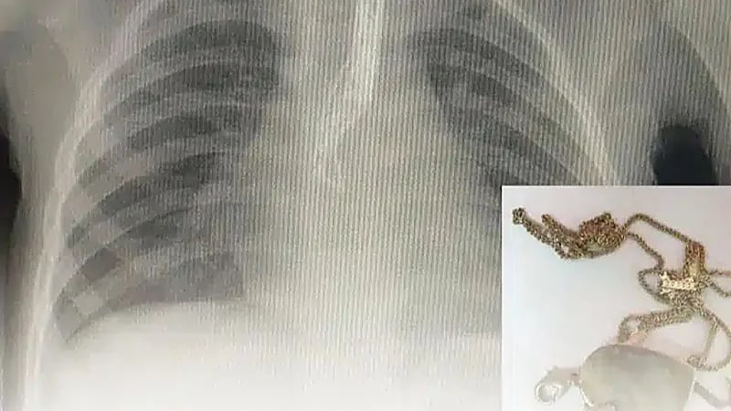 “الفرق الطبية“ تنجح في إنقاذ حياة طفلة ابتلعت “قلادة” بالمدينة المنورة