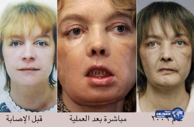 صاحبة أول وجه مزروع في العالم تفارق الحياة.. شاهدوا كيف كان وجهها وكيف أصبح!!