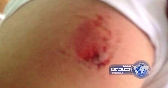 مختل عقلياً يعضّ أحد رجال الأمن في الحرم المكي