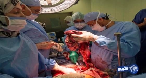 استئصال ورم نادر من بطن خمسيني بمدينة الملك عبد الله الطبية