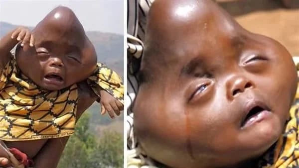 سيدة تنجب مولودا استثنائيا بـ رأس هرمي ووالده يتركه