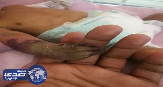 بتر كف رضيع جازان بأحد المستشفيات الخاصة بعسير