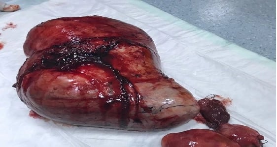 مجمع الملك فيصل يُنهي معاناة أربعينية من ورم ليفي بالرحم