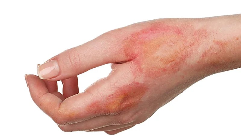 بالفيديو .. حروق تستدعي الذهاب فورا إلى المستشفى