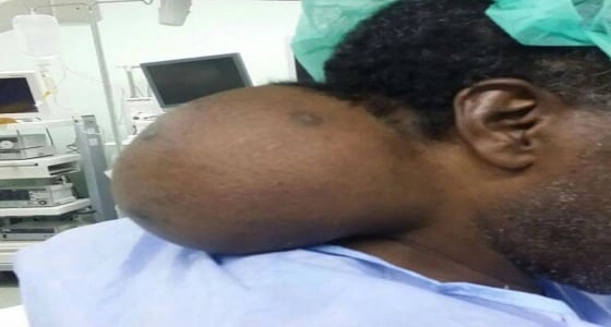 مستشفى بـ " بيشة " تستأصل ورم عمره 20 عام لخمسيني