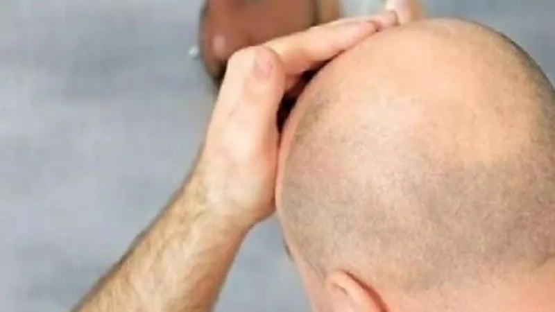 اكتشاف جديد يساعد في علاج الصلع