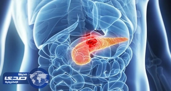 تطبيق جديد على الهاتف الذكي للكشف عن سرطان البنكرياس