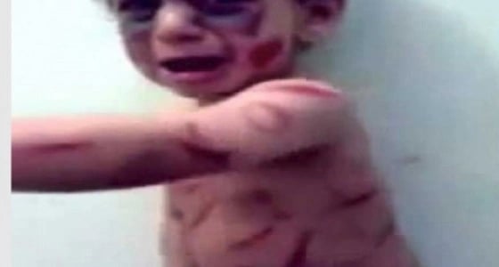 سيدة تكسر يد طفلها وتحرق جسده لغرض التسول به