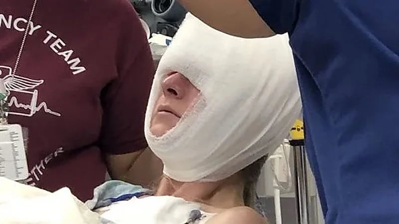 دب متوحش يفتك بجمجمة سيدة وينهش وجهها