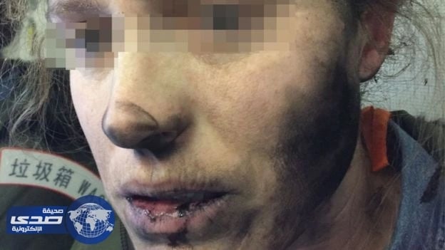 بالصور.. انفجار سماعة رأس بوجه سيدة يٌصيبها بحروق