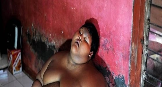 أسمن طفل في العالم يذهل الأطباء بتحوله