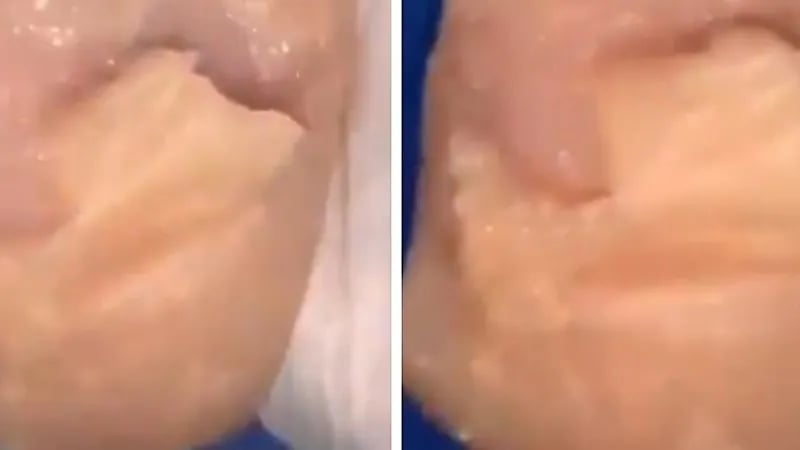 شاهد.. فتاة تلصق قطعة دجاج في كتفها ليتم تطعيمها  باللقاح بدلا من جسمها