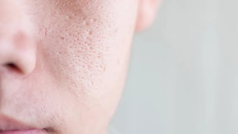 بالفيديو.. أسباب توسّع المسامات في البشرة وظهور الرؤوس السوداء