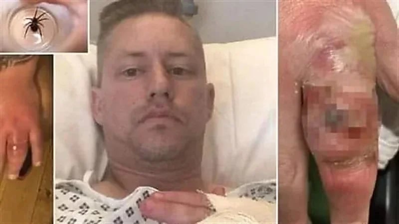 لدغة عنكبوت مميتة تسمم جسد رجل