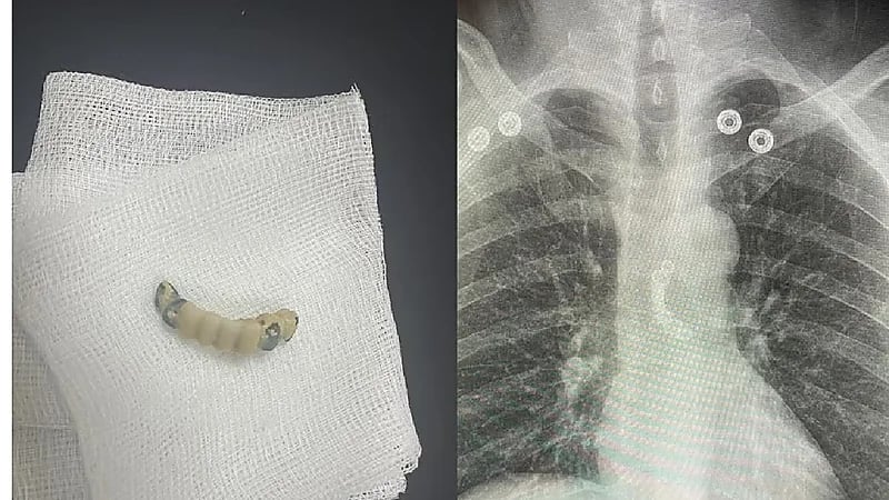 استخراج طقم أسنان من مرئ سبعيني ابتلعه بالخطأ بالمدينة