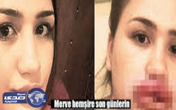 بالصور.. عملية تجميل لفتاة تركية تودي باستئصال الشفتين
