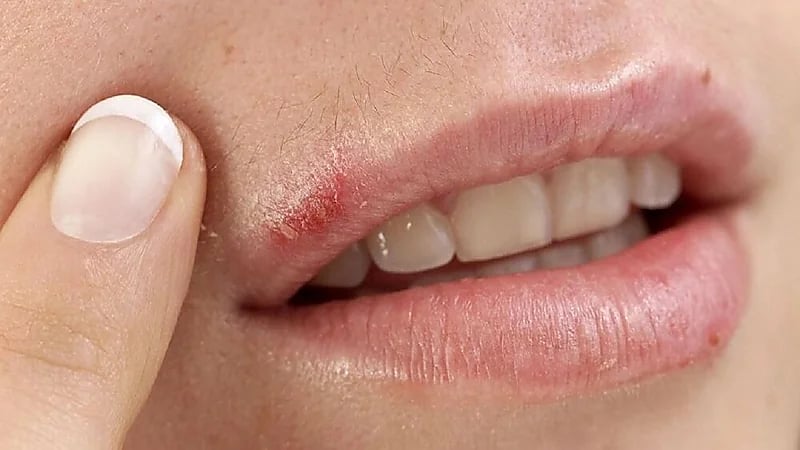 أسباب ظهور تقرحات الفم واللثة وطرق علاجها