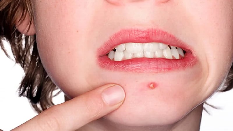 علامة شائعة تنذر بالإصابة بـ "سرطان الجلد"