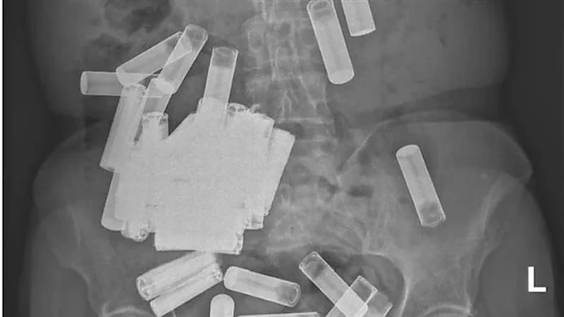 حالة أبهرت الأطباء.. العثور على 55 بطارية قلم داخل معدة سيدة