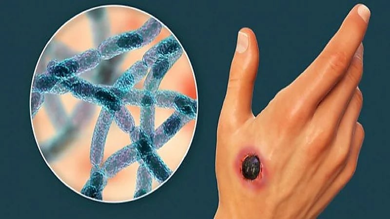 وباء الجمرة الخبيثة يثير الرعب في روسيا