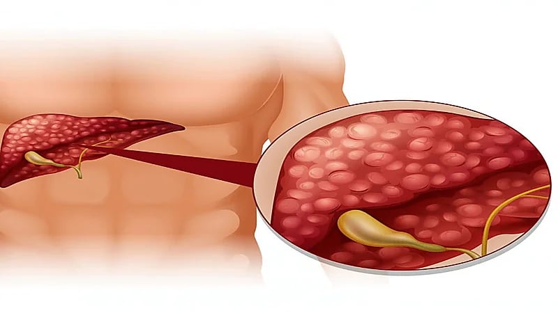 زيادة الوعي بسرطان البنكرياس يساهم في تحسين فرص العلاج