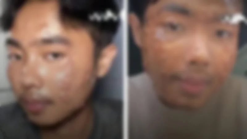 شاب يُصاب بعدوى جلدية بسبب الملابس المستعملة