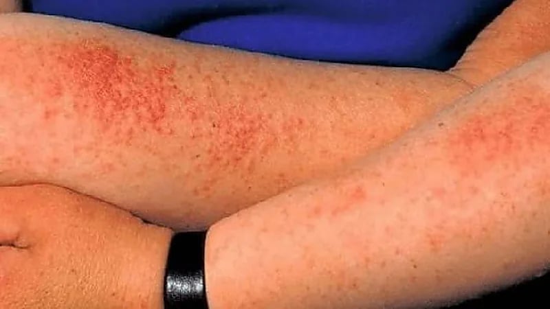 استشاري: التسمم الشمسي ليس تسممًا فعليًا بل التهاب حاد يهدد الجلد .. فيديو