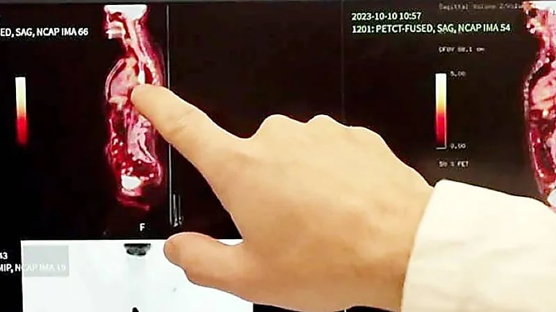 علاج ثوري للسرطان: تقنية نانوية تستهدف الخلايا بدقة دون جراحة